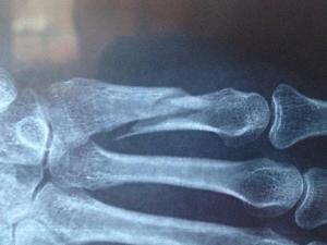 El minusválido digital